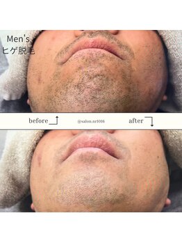 エヌアール(NR)/men's ヒゲ脱毛
