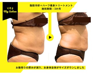 イエス マイサロン(yes My Salon)/脂肪冷却＋痩身施術症例