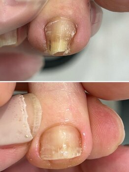 ヴィアンジュ 浦和コルソ店(Vie Ange)の写真/【巻爪＋足爪ケア】でお悩み解決！フットネイルの前にケアで綺麗な足元に♪ベテラン施術者による丁寧ケア