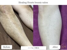 ヒーリングハーツ(Healing Hearts)/メンズW脱毛あし！