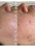 【繰り返す肌荒れ&ニキビケアに】1番人気◇赤み改善×水光肌導入15900→12300