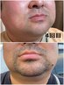 ★男性限定【ヒゲ脱毛全顔】毎朝のヒゲ剃りをラクにお得な6回回数券