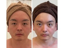 美人バスト 豊橋店/◇小顔症例◇【小顔/豊橋/愛知】