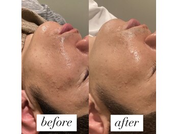 ビーアイリー(Be irie)/肌管理ハーブピーリング