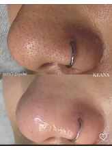 メンズプシュケ(men's PSYCHE)/毛穴エステ