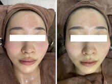 ホワイトアクア 岐阜店(WHITE AQUA)/ハーブピーリング/岐阜/ニキビ