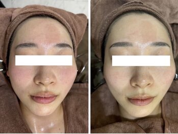 ホワイトアクア 岐阜店(WHITE AQUA)/ハーブピーリング/岐阜/ニキビ