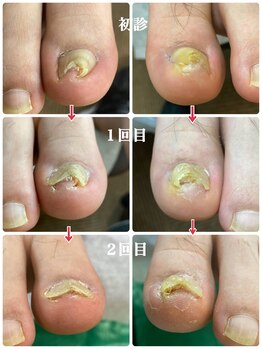 一宮巻き爪センター/巻き爪