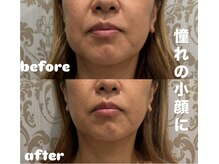 シャルム(CHARME)の雰囲気(小顔コルギ×レモンボトル◎憧れのモデルさんの様な小顔に♪)