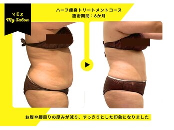 イエス マイサロン(yes My Salon)/ハーフ痩身トリートメント症例