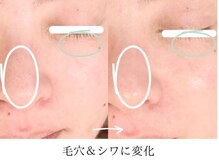 こもれび/１回のお手入れでの変化