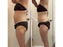クールスパ(COOL SPA)/40代女性 お腹症例