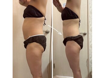 クールスパ(COOL SPA)/40代女性 お腹症例