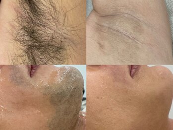 脱毛専門サロン エリクサー(Elixir)/Before After