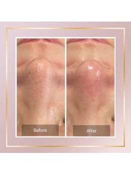 リシェス(Richesse)/エクストラクション☆初回¥9990