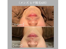 フォルチェ 春日(Folche)/男性の頑固な髭もきれいに