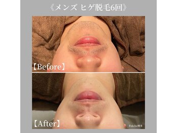 フォルチェ 春日(Folche)/男性の頑固な髭もきれいに