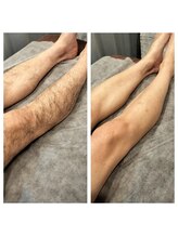 シャンティ(Shanti)/メンズ☆ワックス脱毛