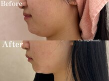 カレンジェビューティー(CarengeBeauty)/四日市エステ/小顔