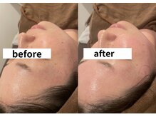 チル(chill)/憧れの美肌に