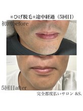 アンドエス(&S.)/最大限に痛みを抑えたひげ脱毛☆