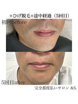 アンドエス(&S.)/最大限に痛みを抑えたひげ脱毛☆