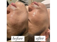 ビーアイリー(Be irie)/肌管理ハーブピーリング