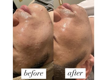 ビーアイリー(Be irie)/肌管理ハーブピーリング