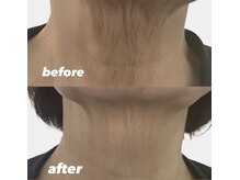 ビビット 久宝寺店(VIVIT)/光フォト/3回照射/たるみ