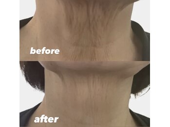 ビビット 久宝寺店(VIVIT)/光フォト/3回照射/たるみ