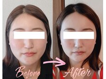 アシュネ(Axiune)/30代★小顔矯正”浮腫み改善”