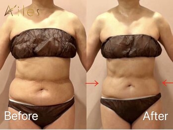 エール 恵比寿店(AILES)/60代ハイボルテージ＋全身リンパ