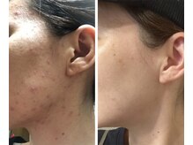 ヨサパーク リュミエール 三鷹(YOSA PARK Lumiere)/☆40代　ニキビ肌の変化