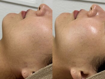 アンリミット 原宿竹下通り店(Une limit)/【頬の毛穴・乾燥感→ツヤ肌に】