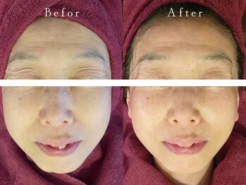 サロン アイプラス(salon i plus)/シワ