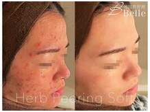 【毛穴|ハーブピーリング】韓国肌管理Belle 京都河原町【3/29 NEWOPEN(予定)】の雰囲気(【お得な回数券◎】ハーブピーリング/毛穴洗浄/ダーマで肌質改善)