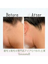 ビビ 土浦Kokokala店(BiVi)/全身脱毛にはうなじ脱毛込☆