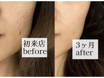 ヒトハナ(hitohana)/ニキビケア開始→3ヶ月後の効果