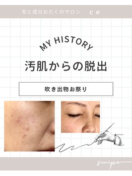 シャルム エスボーテ(charme Esbeaute)/ハーブピーリング