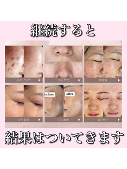 ホリシア 博多(HORISHIA)/ララピール/ハーブピーリング