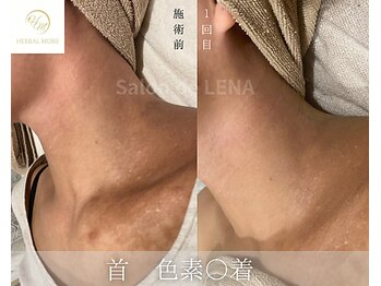 サロンドレナ 名駅店/ハーブピーリング サロンドレナ