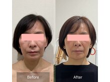マルウル(maluulu)/50代　3年　BeforeAfter