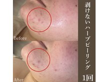 サロンドペシェ(salon de peche)/20代＊ハーブピーリング1回