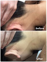 エステティック レイビス 青森店(RAYVIS)/うなじ脱毛で垢抜け！