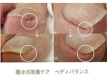 プティット シュシュ(Petit Chouchou)/巻爪改善ジェル