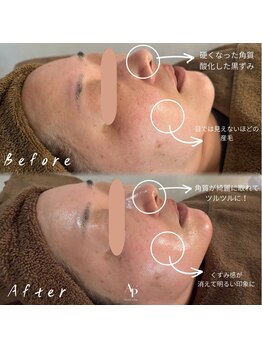 アピュルテ(A purete')/白玉WAX Before→After