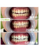 ルブラン 奈良店(Le Blanc)/6回目でここまで白く！
