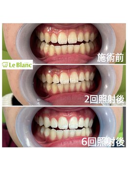 ルブラン 奈良店(Le Blanc)/6回目でここまで白く！