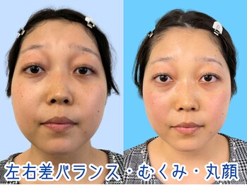 ナチュラルビューティーフェイス 横浜(NBF)/むくみ目の下のクマ / 横浜小顔