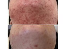 ママナ(mamana)/ニキビにお悩みの方。。